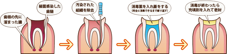 根管治療