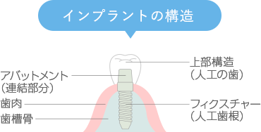 インプラントの構造