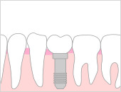 インプラント