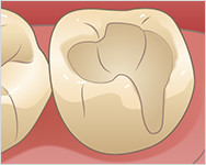 むし歯を削り、綺麗に形を整える