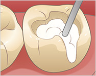 充填物を直接塗布する。
