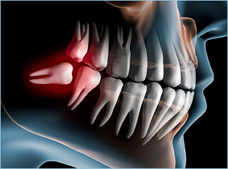 親知らずの抜歯