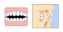 前歯が開いてしまう(開咬)