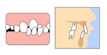 下の歯がほとんど見えない(過蓋咬合)