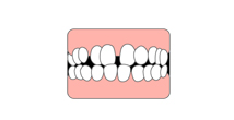 歯と歯の間に隙間がある(すきっ歯)
